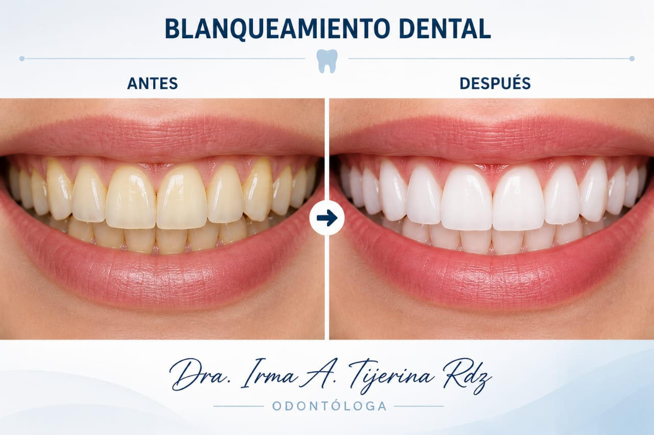Blanqueamiento dental antes y después